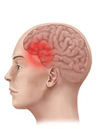 The Migraine And Headache
